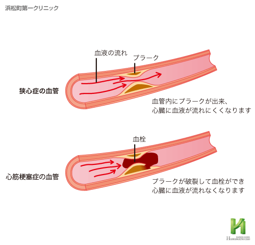 手術 カテーテル 心筋 梗塞