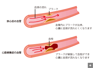 心筋梗塞の血栓