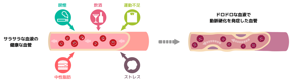 動脈硬化が進んだ血管