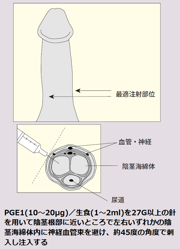 ICI療法について｜【浜松町第一クリニック】