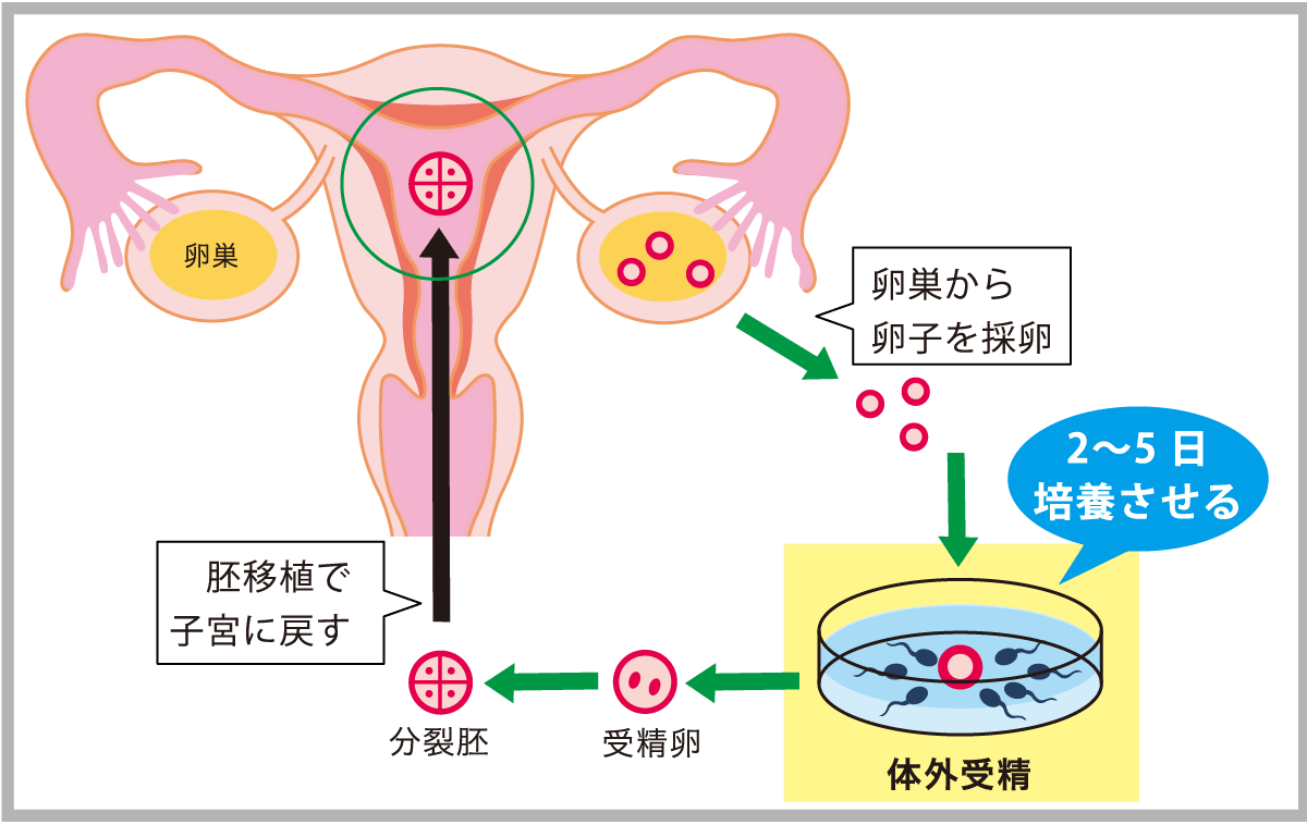 しない 原因 授精 妊娠 人工