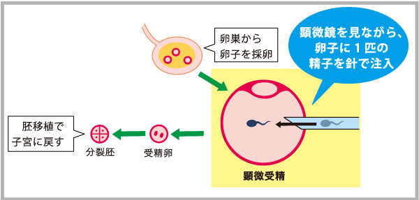 イブプロフェンは勃起不全に悪いです