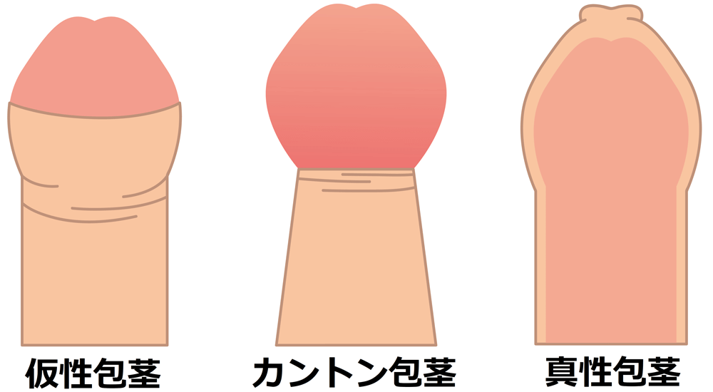 勃起　包茎 