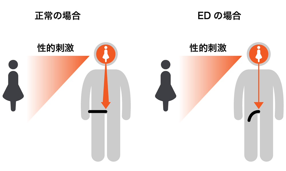 正常な場合とEDの場合