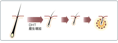DHT産生増加